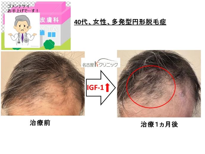 円形脱毛症　病院